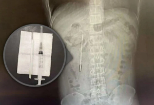 20 лет жил с градусником в животе, потому что боялся всем об этом рассказать