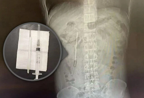 20 лет жил с градусником в животе, потому что боялся всем об этом рассказать